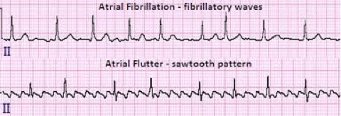 An image shows two ECGs. The upper one shows atrial fibrillation. The lower one shows atrial flutter.