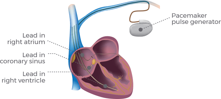 This image shows a biventricular pacemaker with three electrical wires: one that paces the right ventricle, one in the right atrium and one in the coronary sinus.