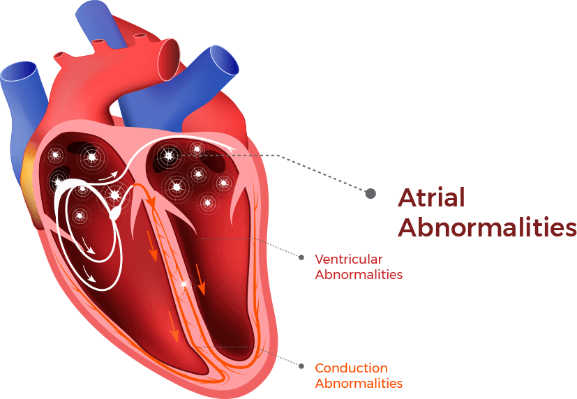 An illustration shows where atrial arrhythmias and abnormalities occur in the heart chamber.