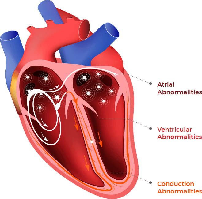 Heart Arrythmia Types & Irregular Heartbeats in Dilated Cardiomyopathy