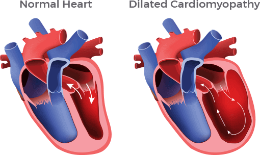 An illustration shows the difference between a normal heart and one with dilated cardiomyopathy.