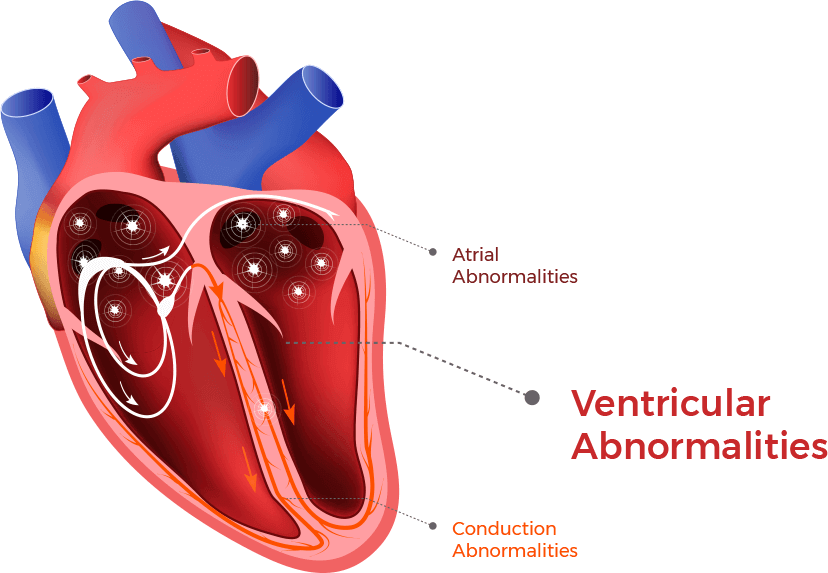 An illustration shows where ventricular arrhythmias and abnormalities occur in the heart chamber.